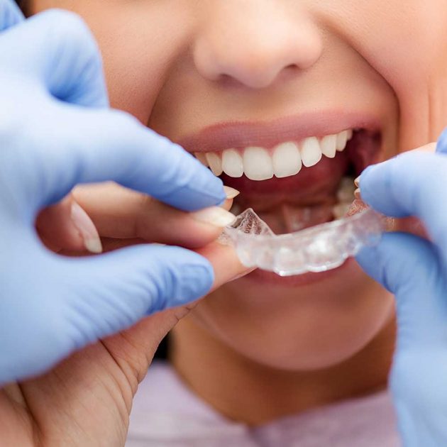 denwest dental clinic clear braces e1655179710970