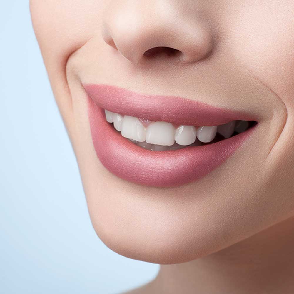 Appealing Smile with Dental Veneers