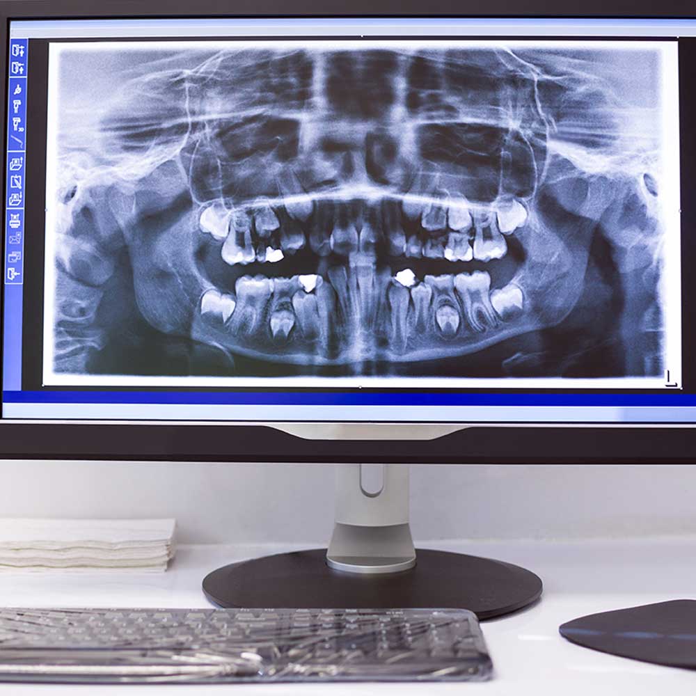 Wisdom teeth Extraction. X-Ray shows the Hidden Wisdom Teeth