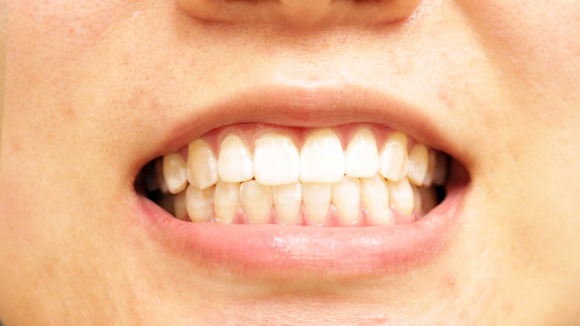 denwest dental teeth whitening after 3 1