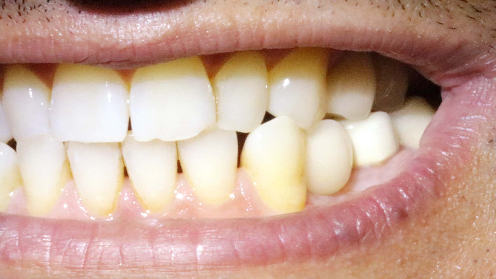 implant single tooth after