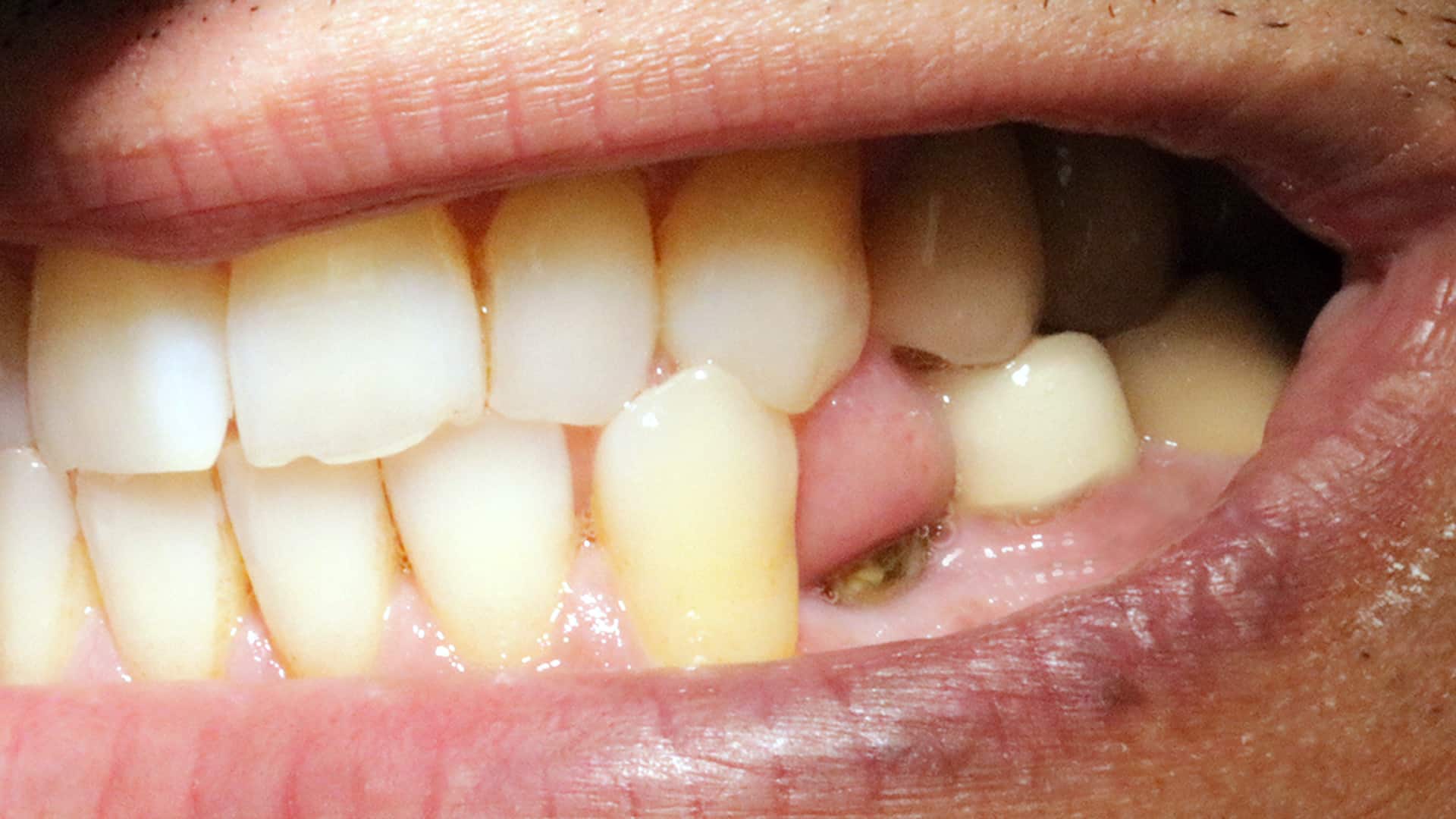 implant single tooth before