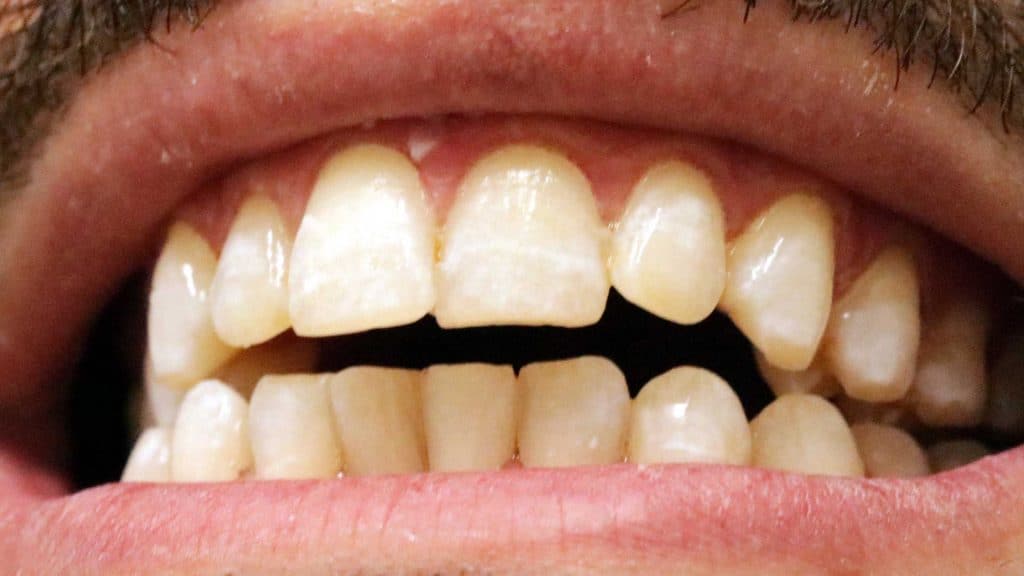 denwest dental teeth whitening after 3