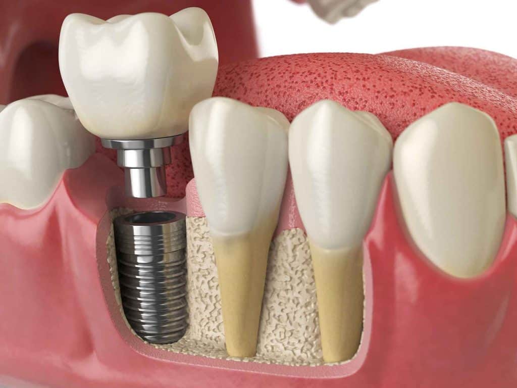 Crown Replacement for Implant Tooth