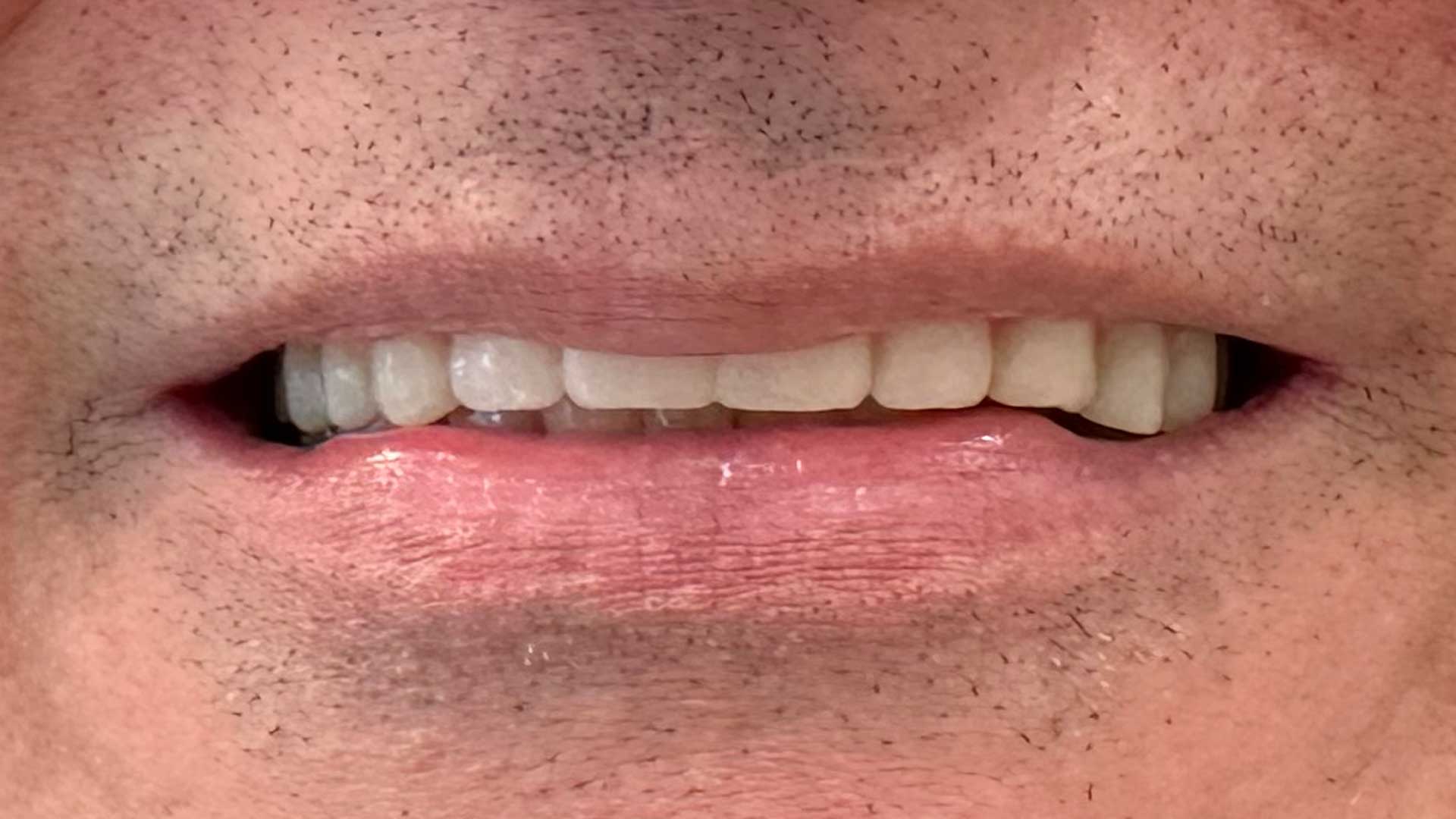 full arch implant bahram after