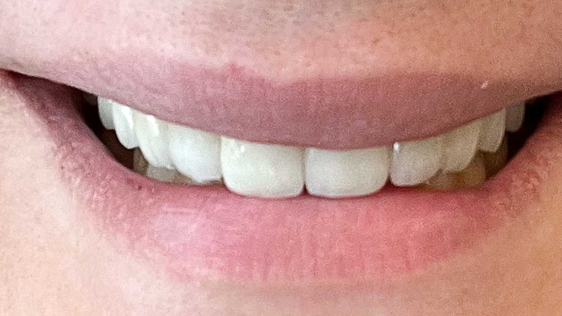 teeth veneer after