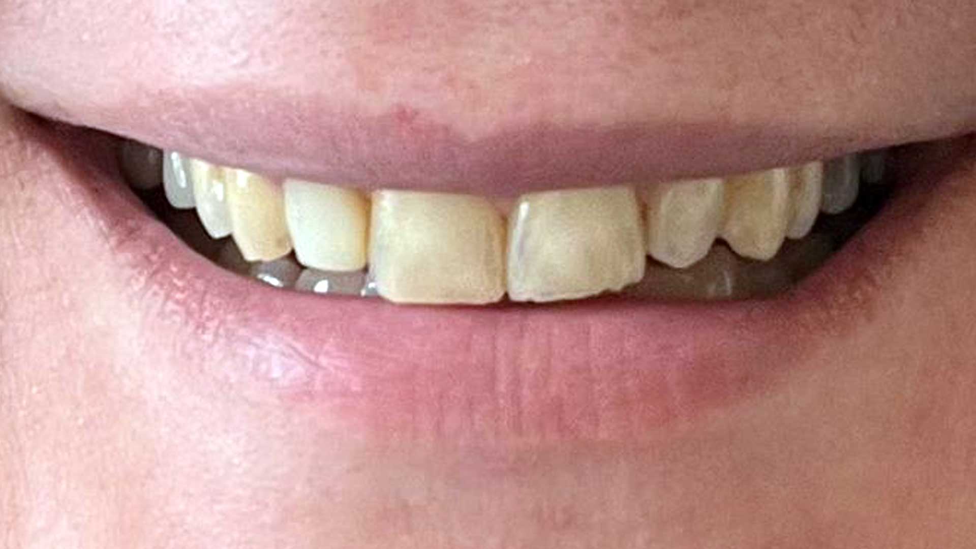 teeth veneer before