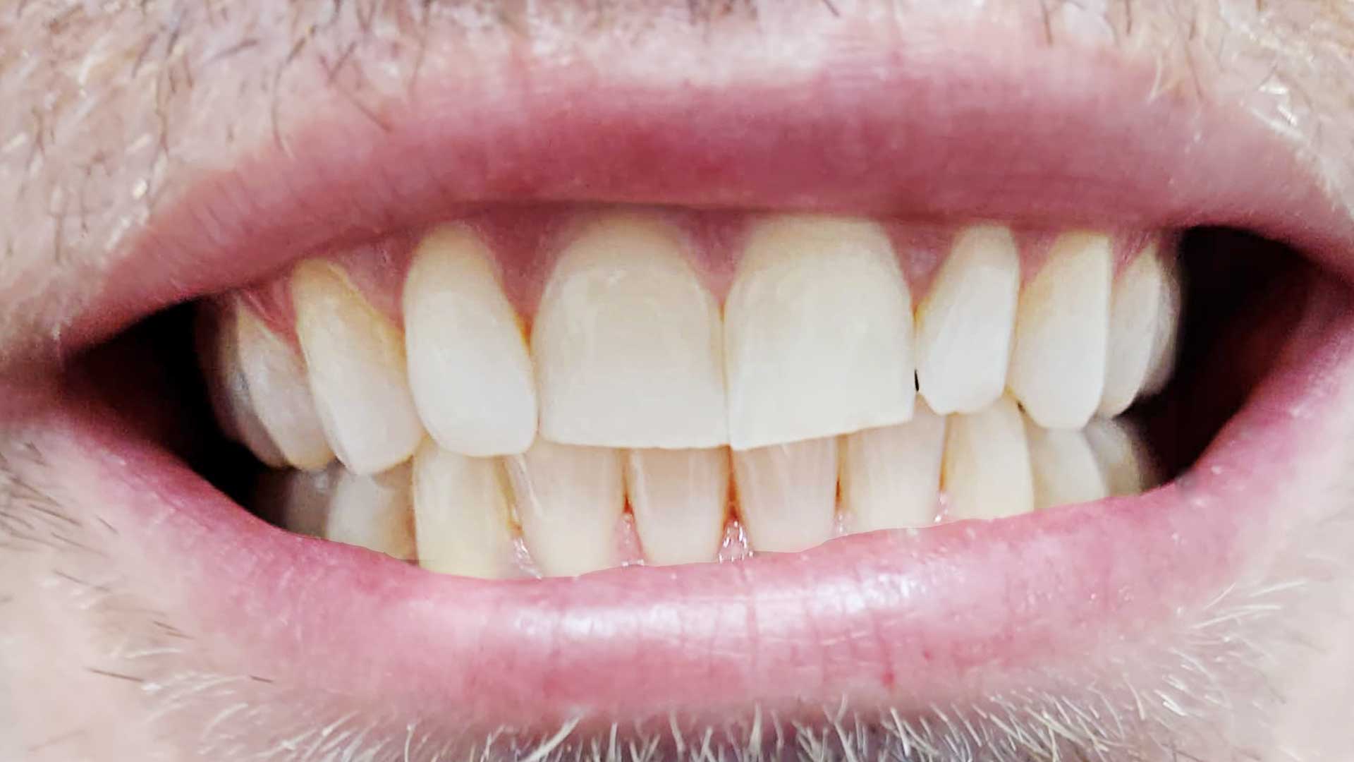 Invisalign orthodontic after dr hamid tamimi