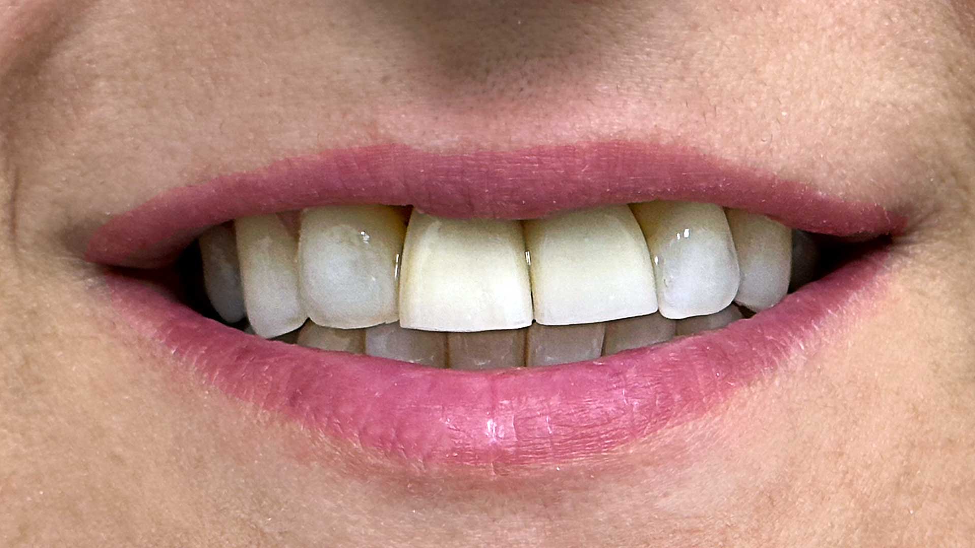 front teeth implant surgery after denwest dental