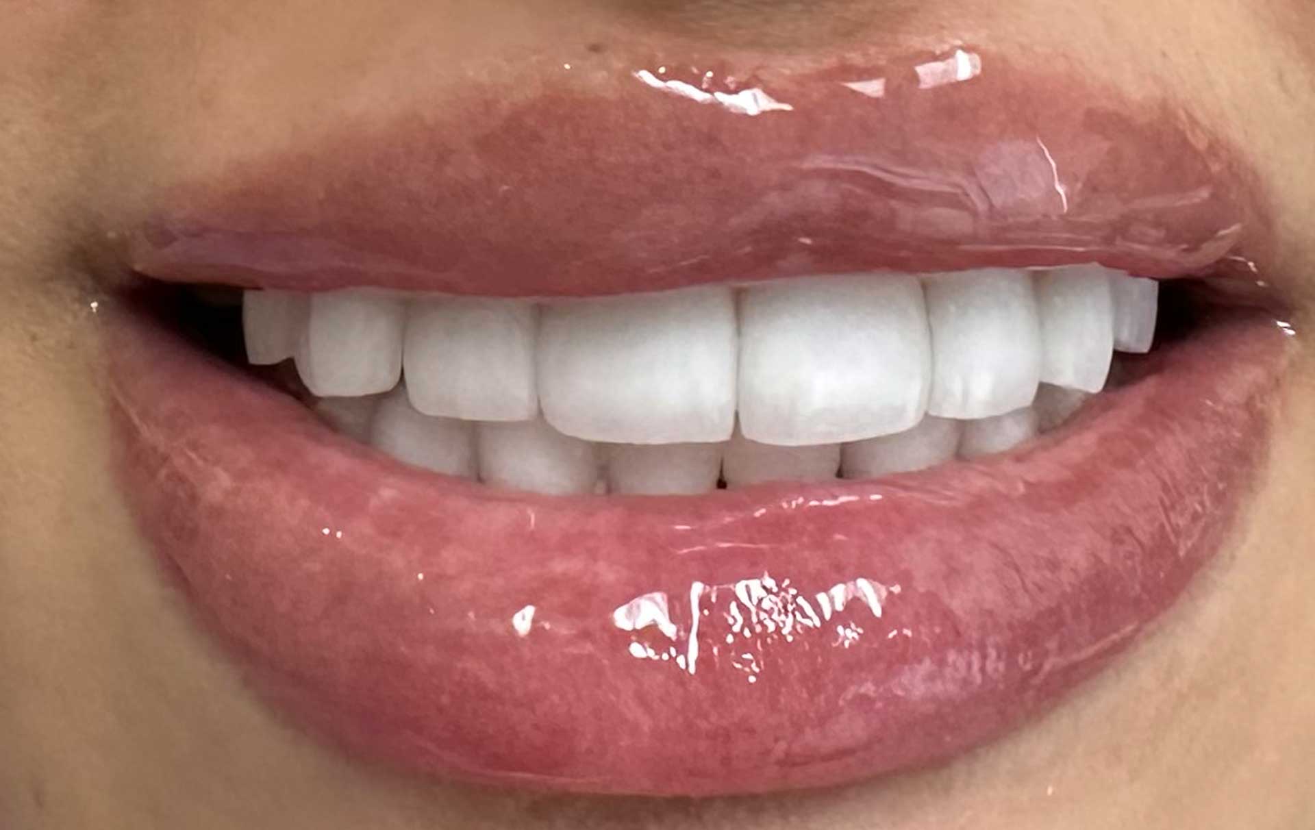 dental veneer after denwest dental