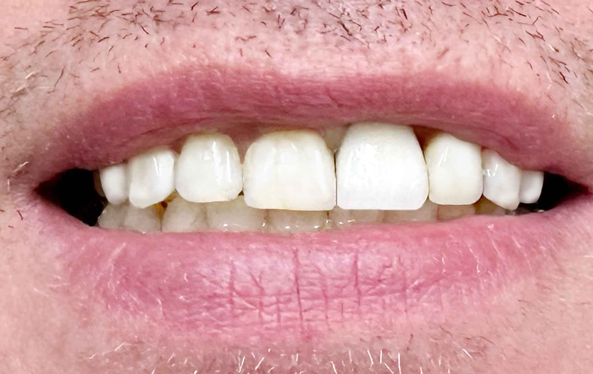front single implant after denwest dental