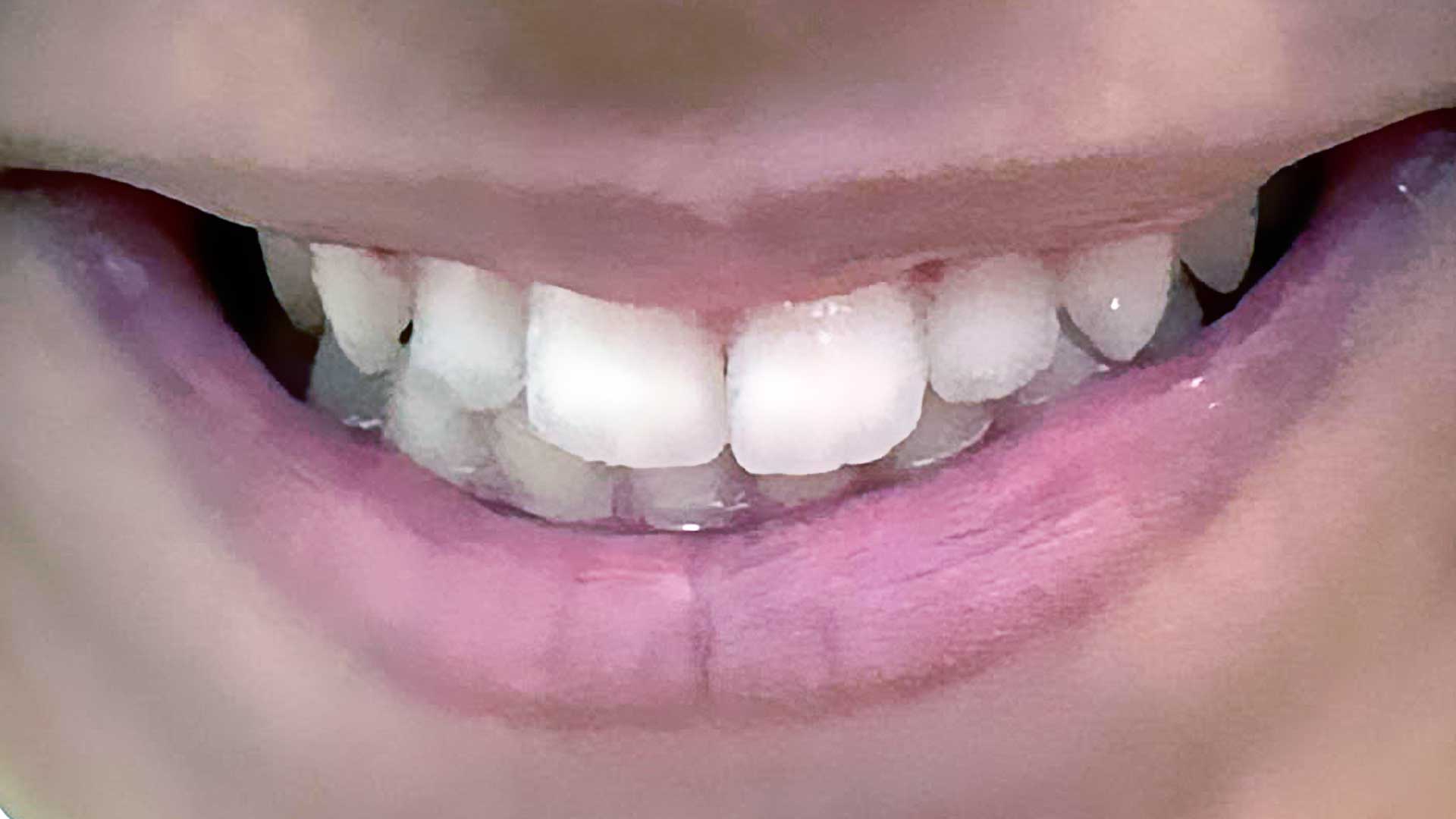 After Invisalign