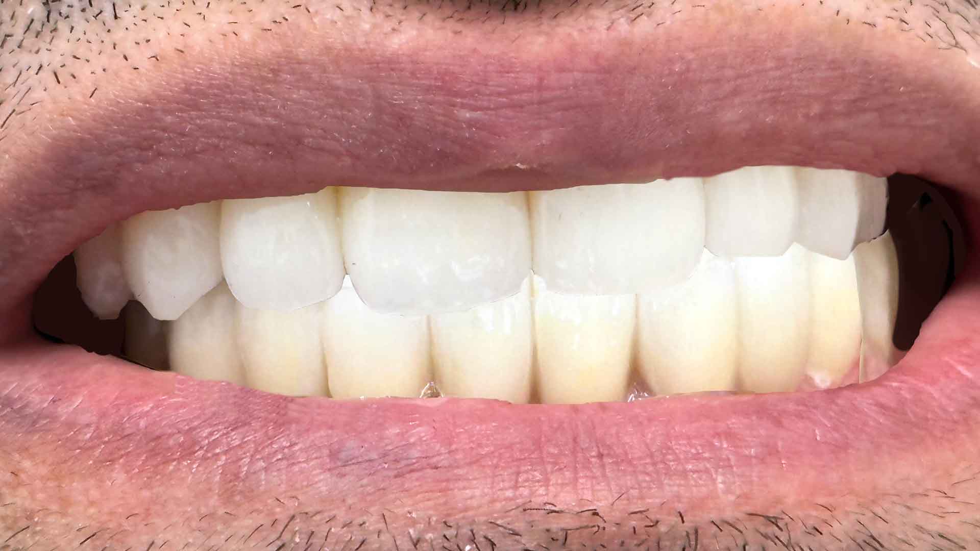 full crown after denwest dental