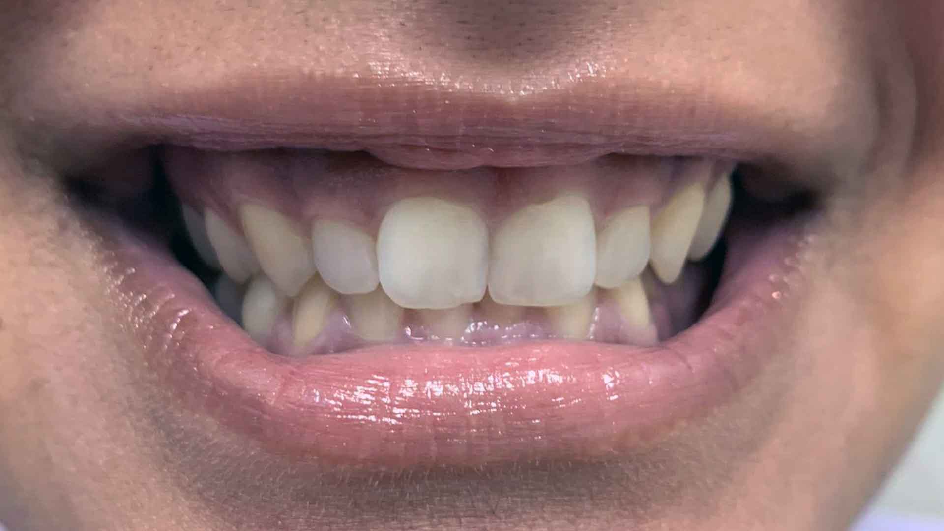 before ortho treatment