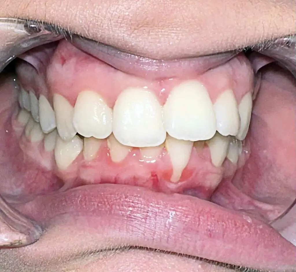 calssI crowding orthodondic treatment