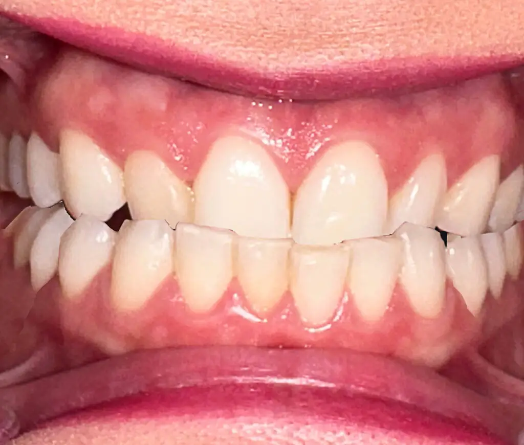 calssIII malocclusion ortho treatment