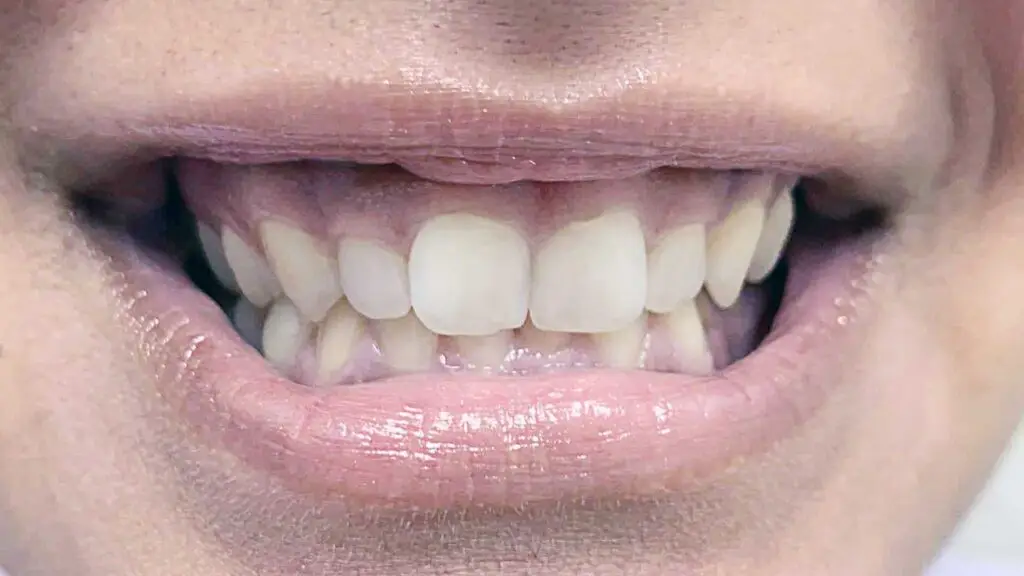 deep bite ortho suresmile