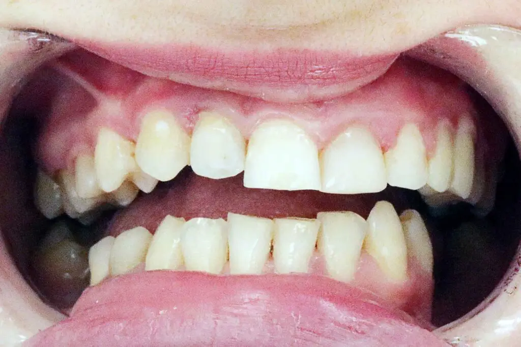 midline discrepancy ortho treatment