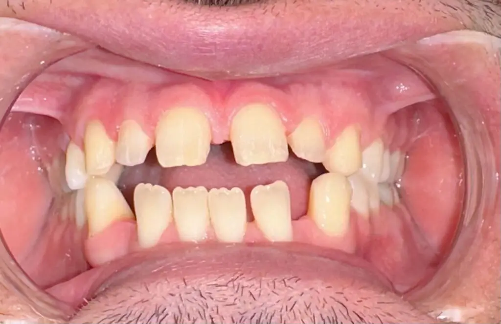 openbite general spacing orthodontic treatment