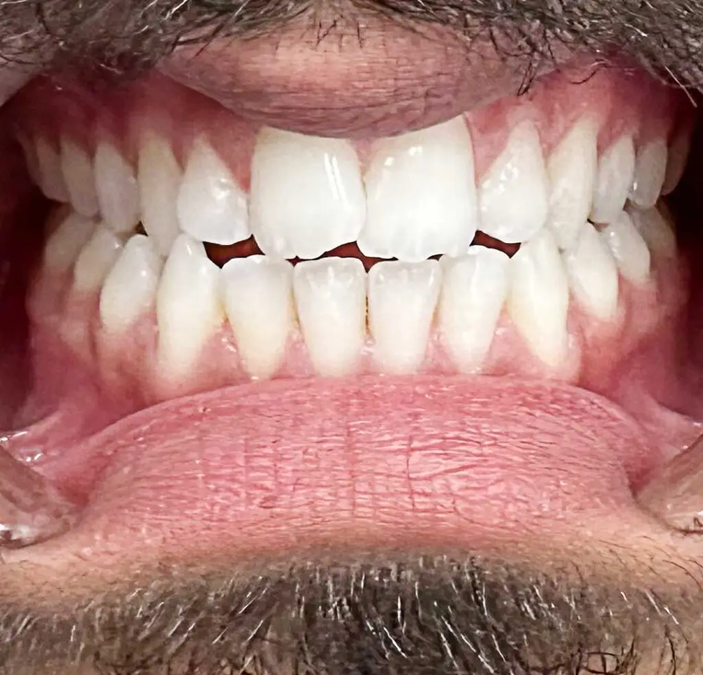 posterior crossbite ortho treatment