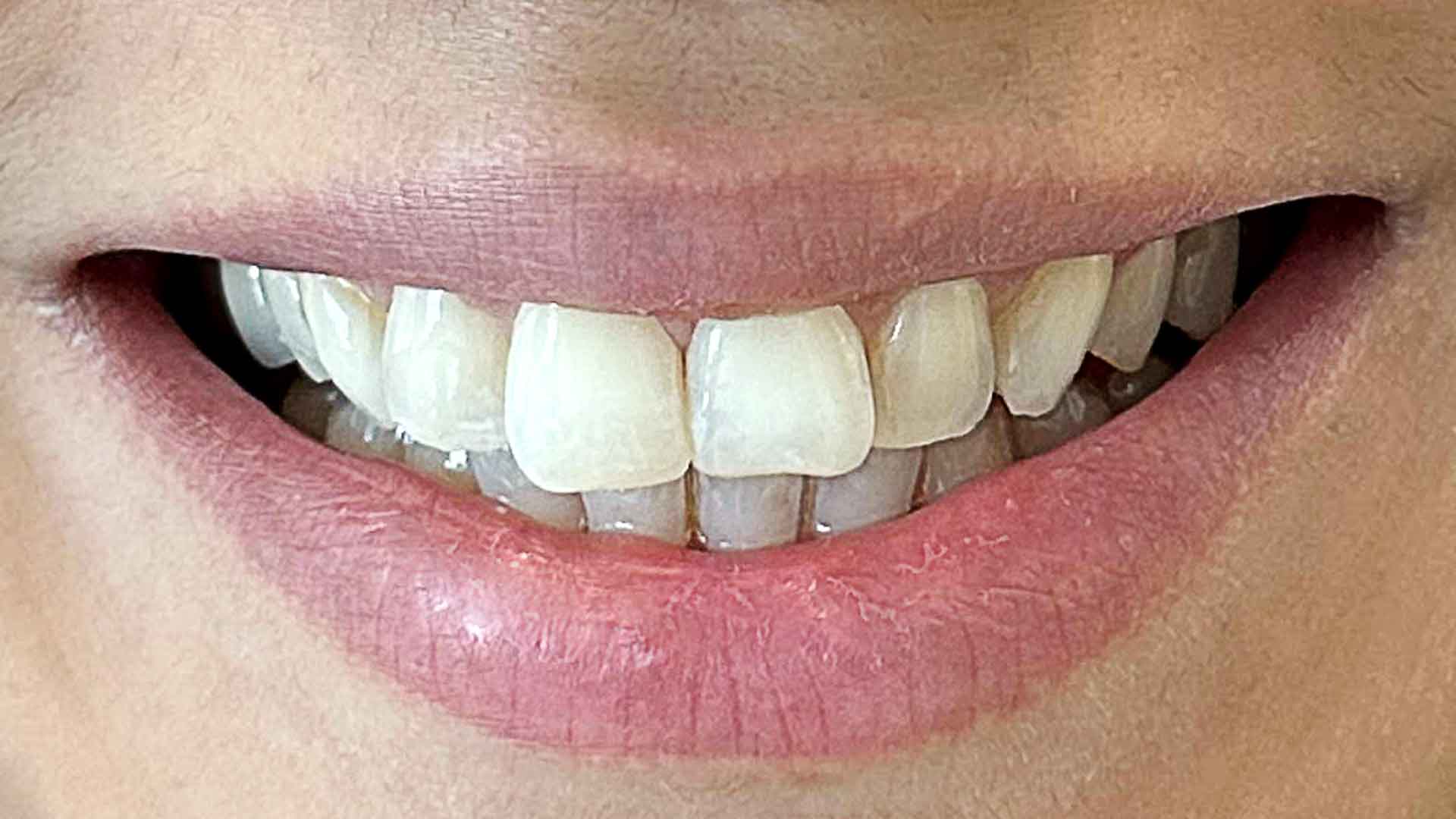 deep bite treatment denwest dental clnic after 1