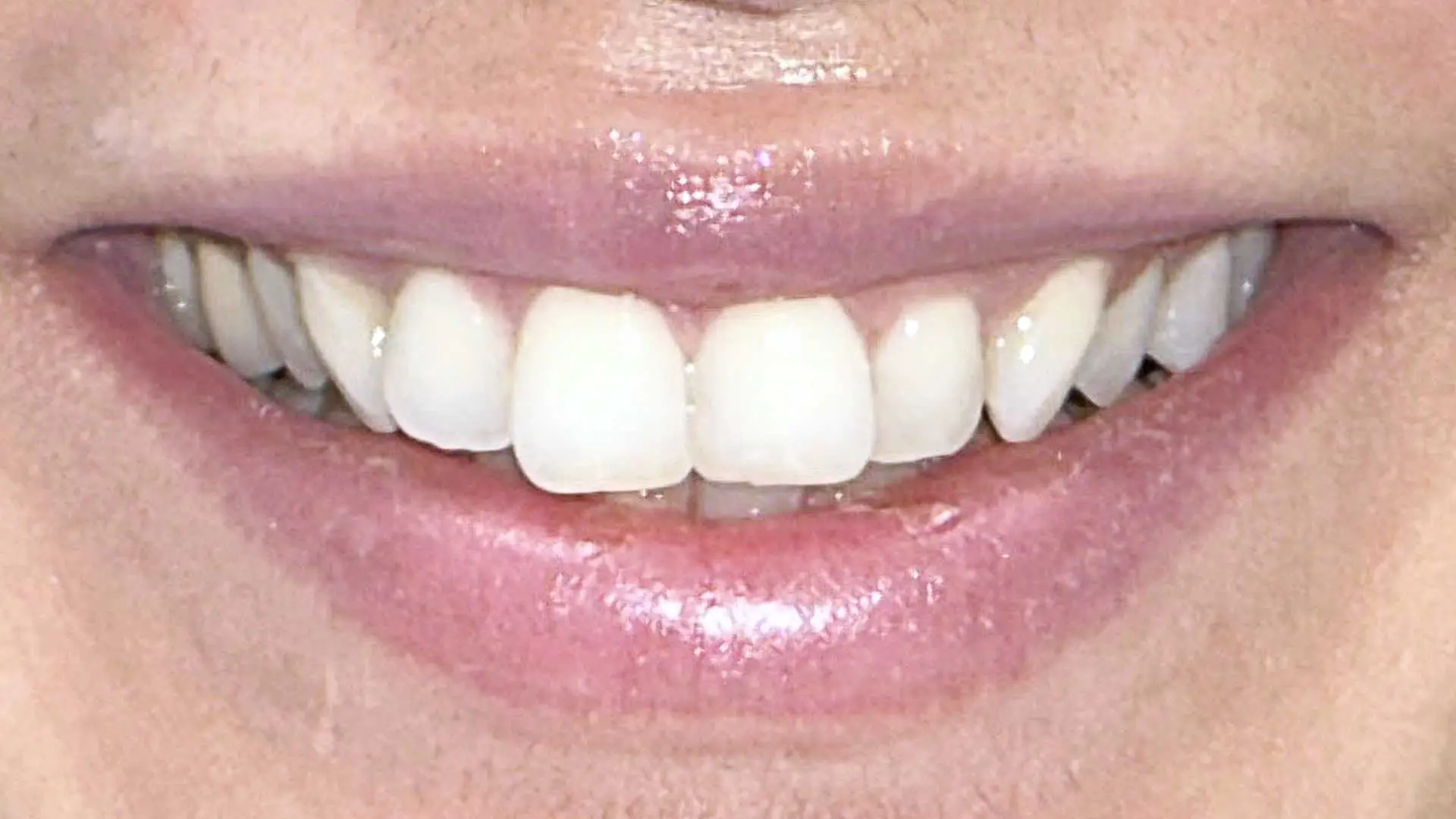 deep bite treatment denwest dental clnic before 1