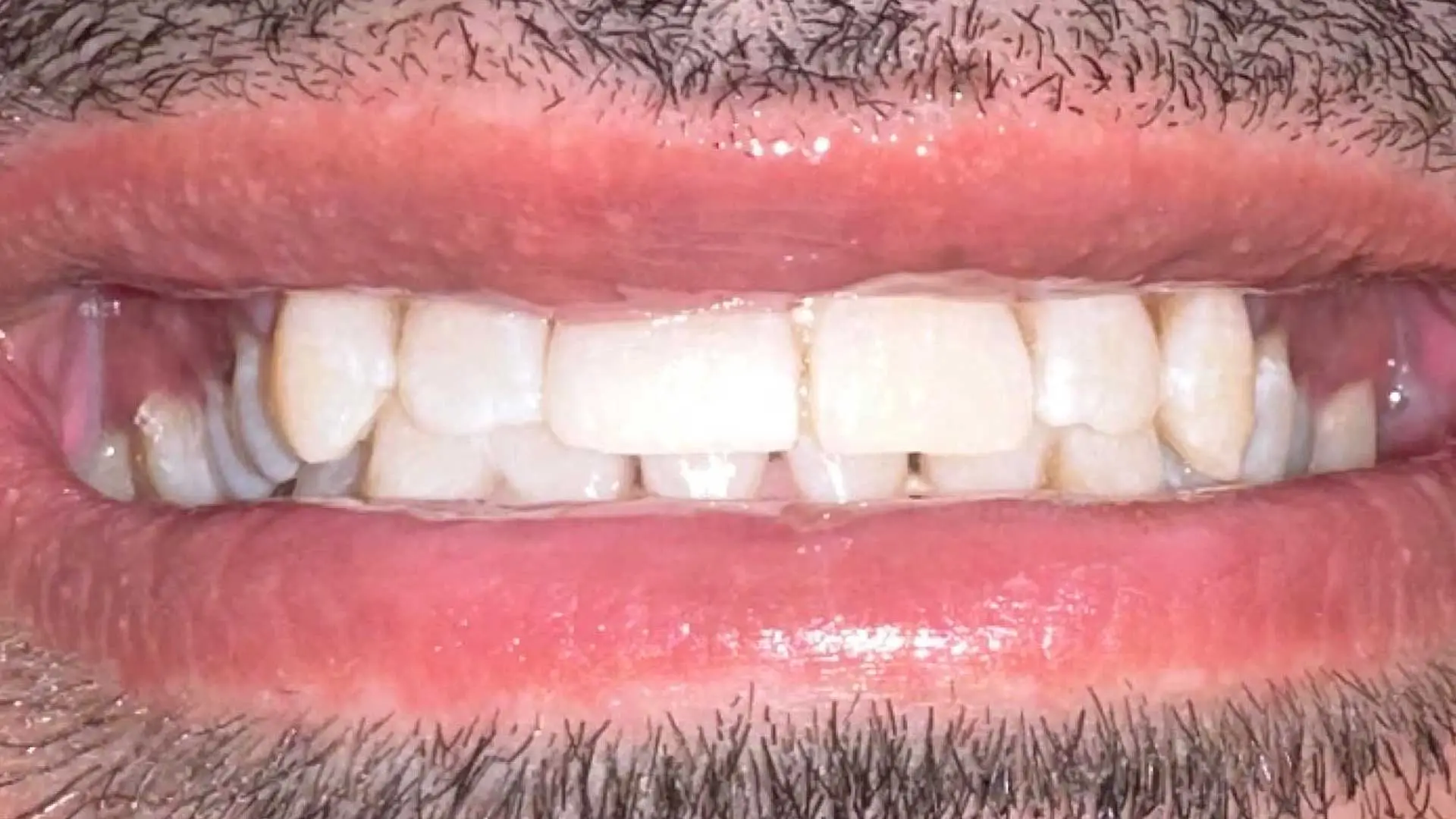 teeth whitening after denwest dental 1