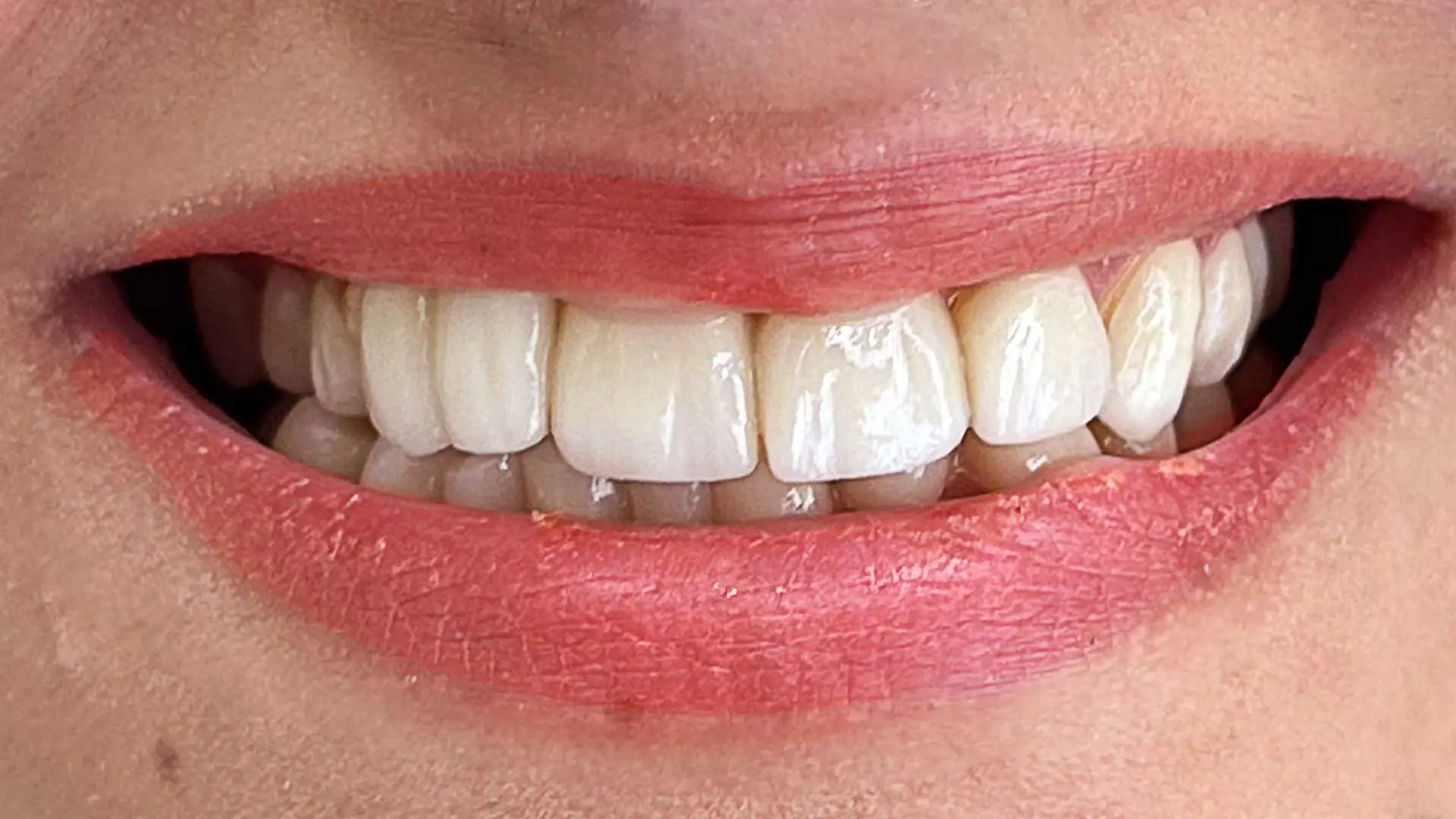 dental case after crown