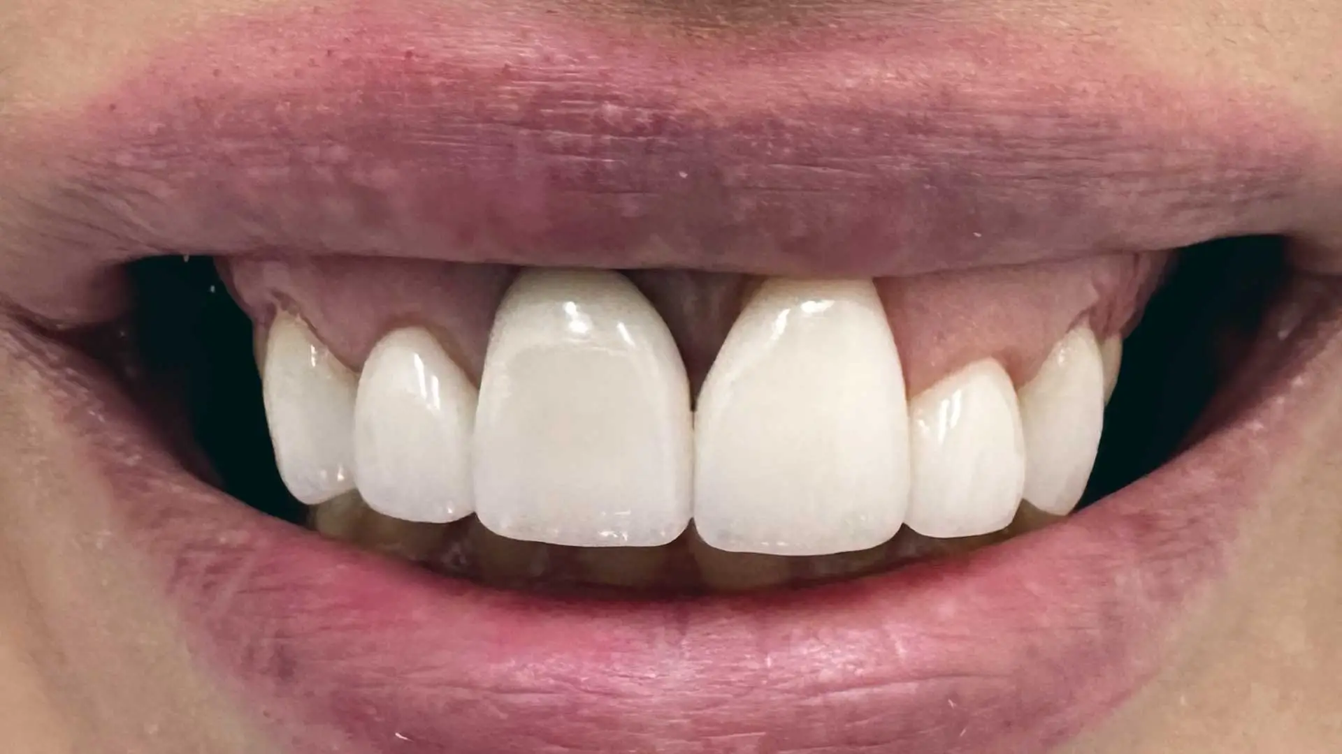 dental case after front crown