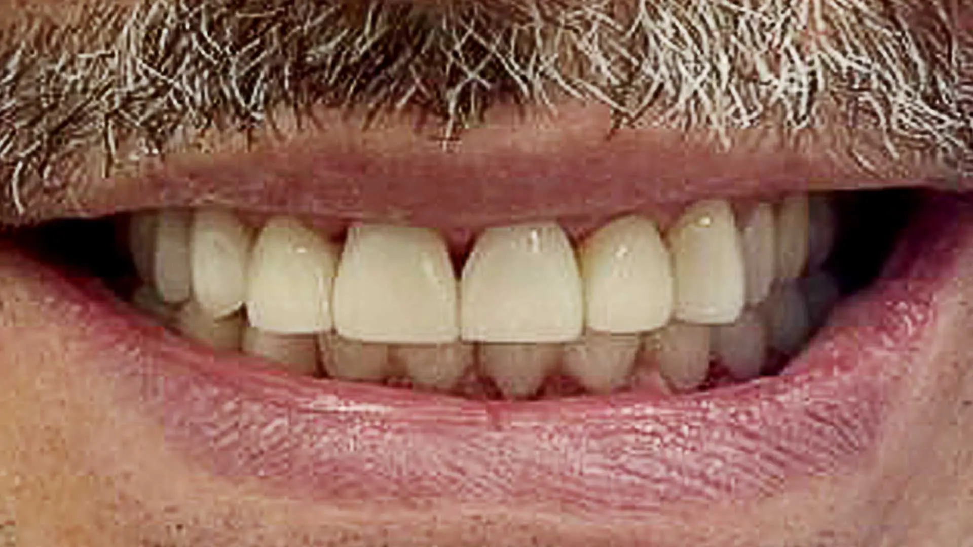 dental case after full crown 1