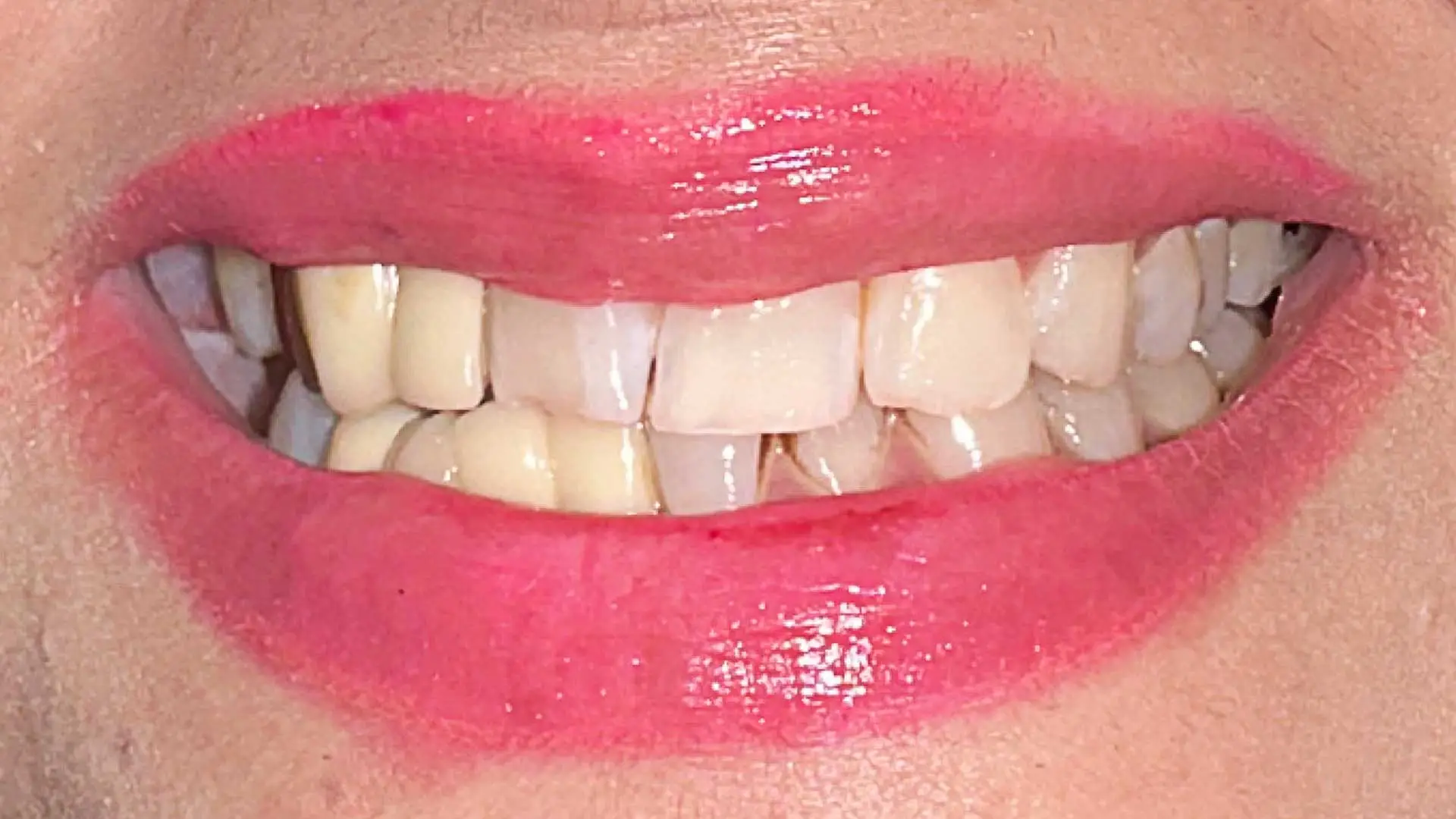 dental case before crown